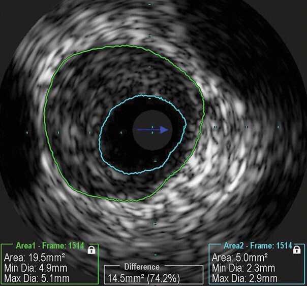 Ivus Image