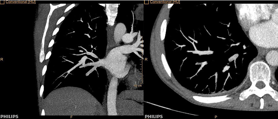 Radiologie embolie pulmonaire