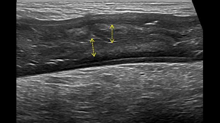 Severe acute form thick submucosal edema