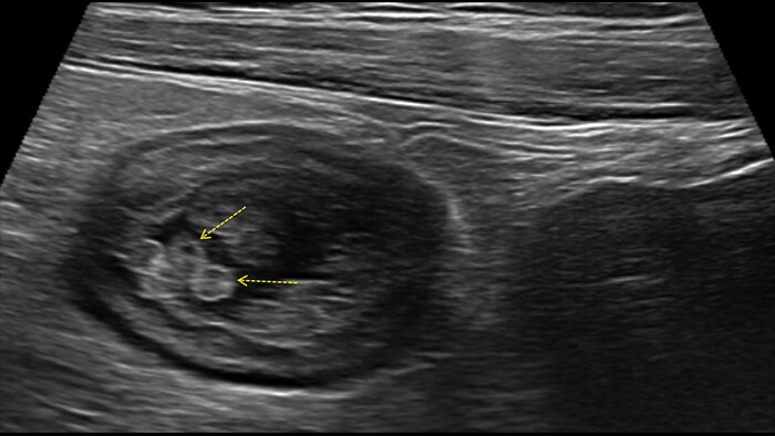 Ulcerative colitis