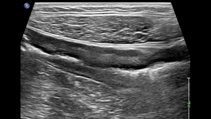 Late form transmural inflammation