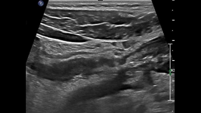 Fibrosis and stenosis  loss of the bowel wall layering