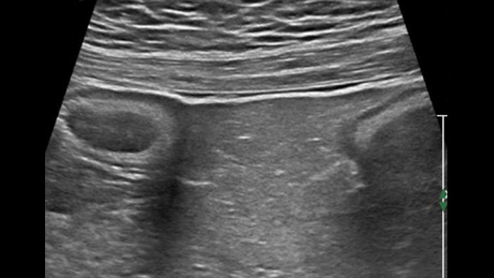 Sclero-lipomatosis  Hypertrophic fat with frosted glass appearance