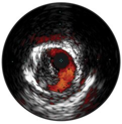 Thrombus