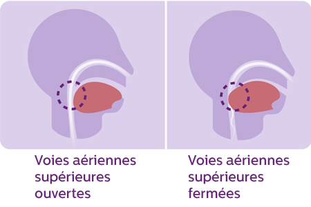 'Illustration de l'obstruction des voies aériennes supérieures en cas d'apnée du sommeil