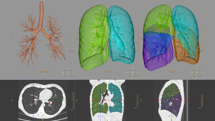 Philips CT Pulmo Auto Results