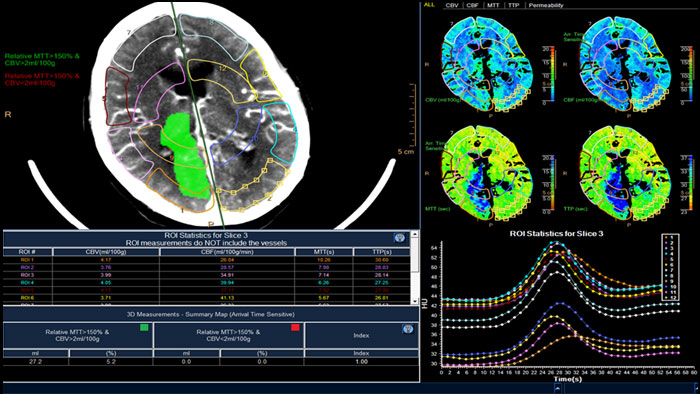 CT Brain perfusion