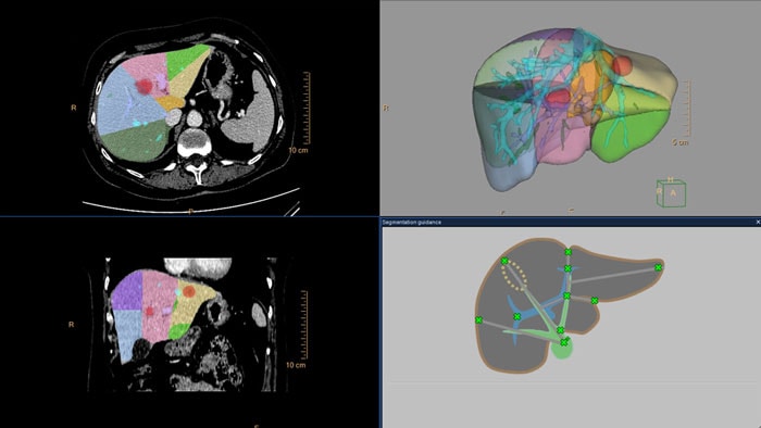 Segmentation automatique du foie en CT