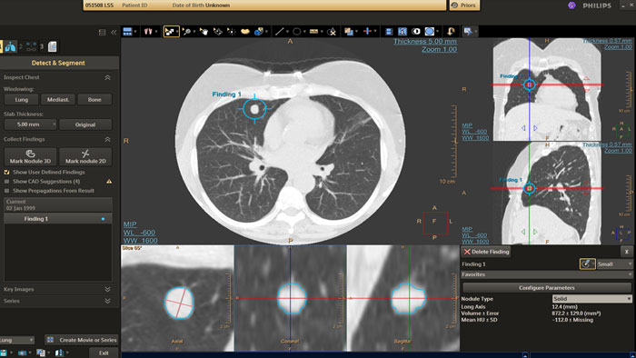 Détection et caractérisation des nodules pulmonaires basés sur l'IA