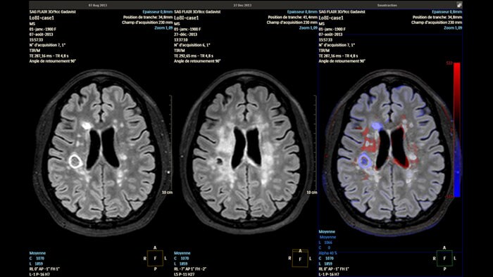 Mettre en évidence les changements neurologiques subtils au fil du temps