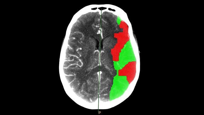 Vignette brain perfusion