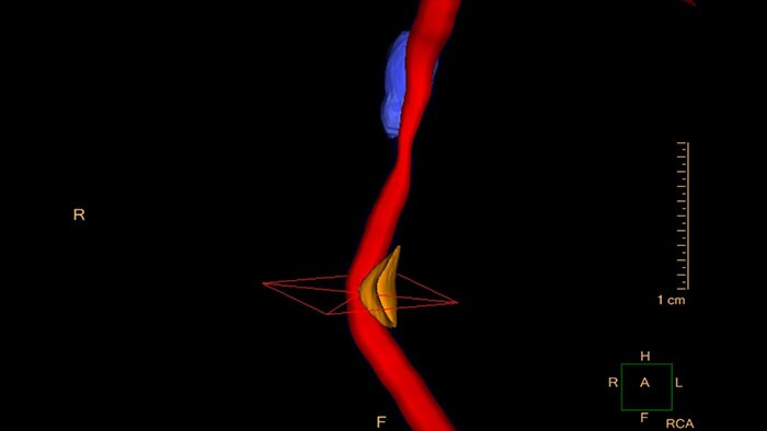 Vignette cardiac plaque assessment