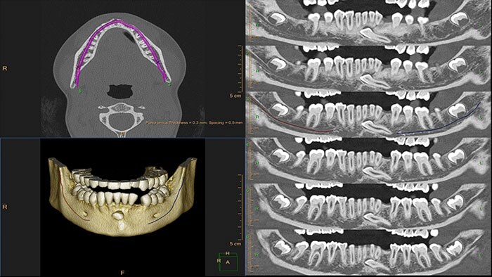 miniature dental planning