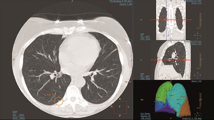 Vignette lung nodule cad