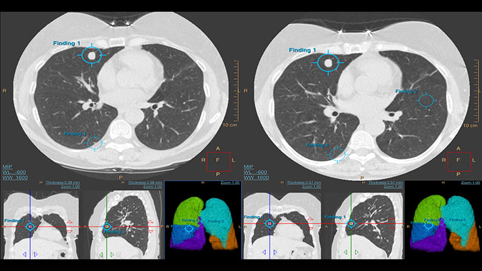 Vignette de l’évaluation d’un nodule pulmonaire