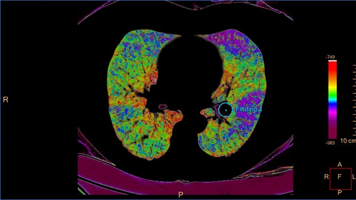 miniature pulmonary artery analysis