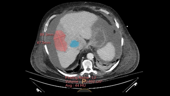 miniature spectral tumor tracking