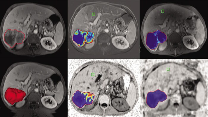 Vignette tumor tracking qeasl