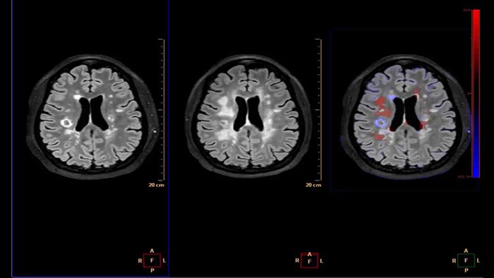 Vignette longitudinal brain imaging