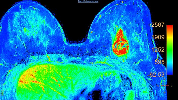 Vignette t1 perfusion