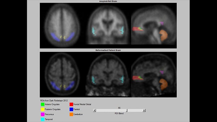 Vignette neuroq amyloid