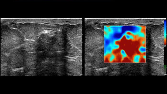 miniature q-app elastography analysis