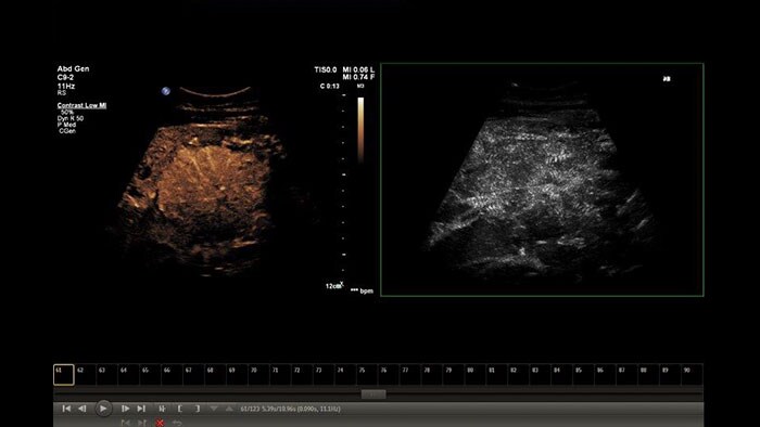 miniature q-app microvascular imaging