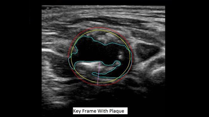 miniature q-app vascular plaque quantification