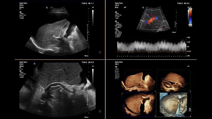 miniature ultrasound viewing