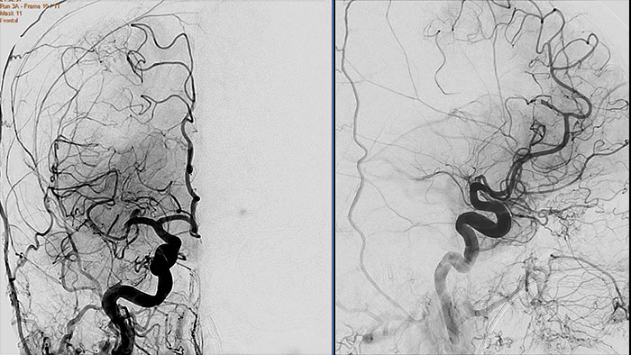 Vignette vascular processing