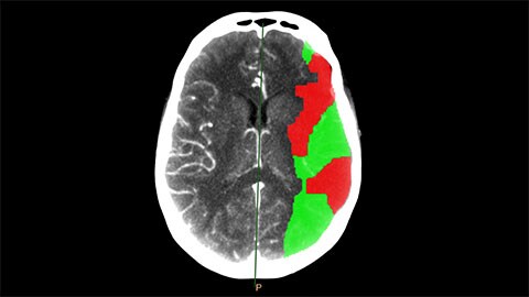 image clinique de ct brain perfusion