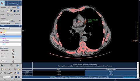 image clinique de ct calcium scoring