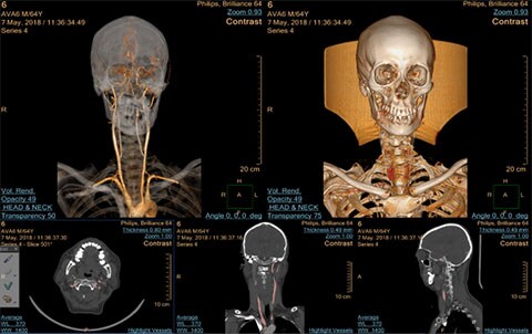 image clinique de multi modality advanced vessel analysis