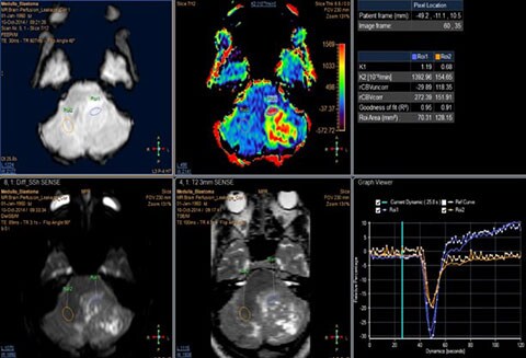 image clinique de mr t2 neuro perfusion