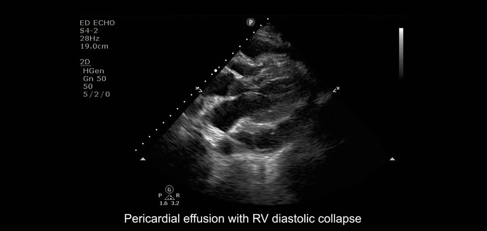 épanchement péricardique avec collapsus diastolique du vd