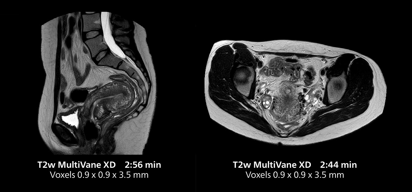 Irm du pelvis deux