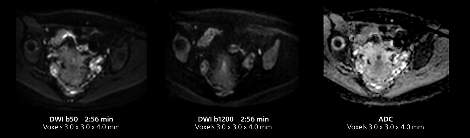 Irm du pelvis