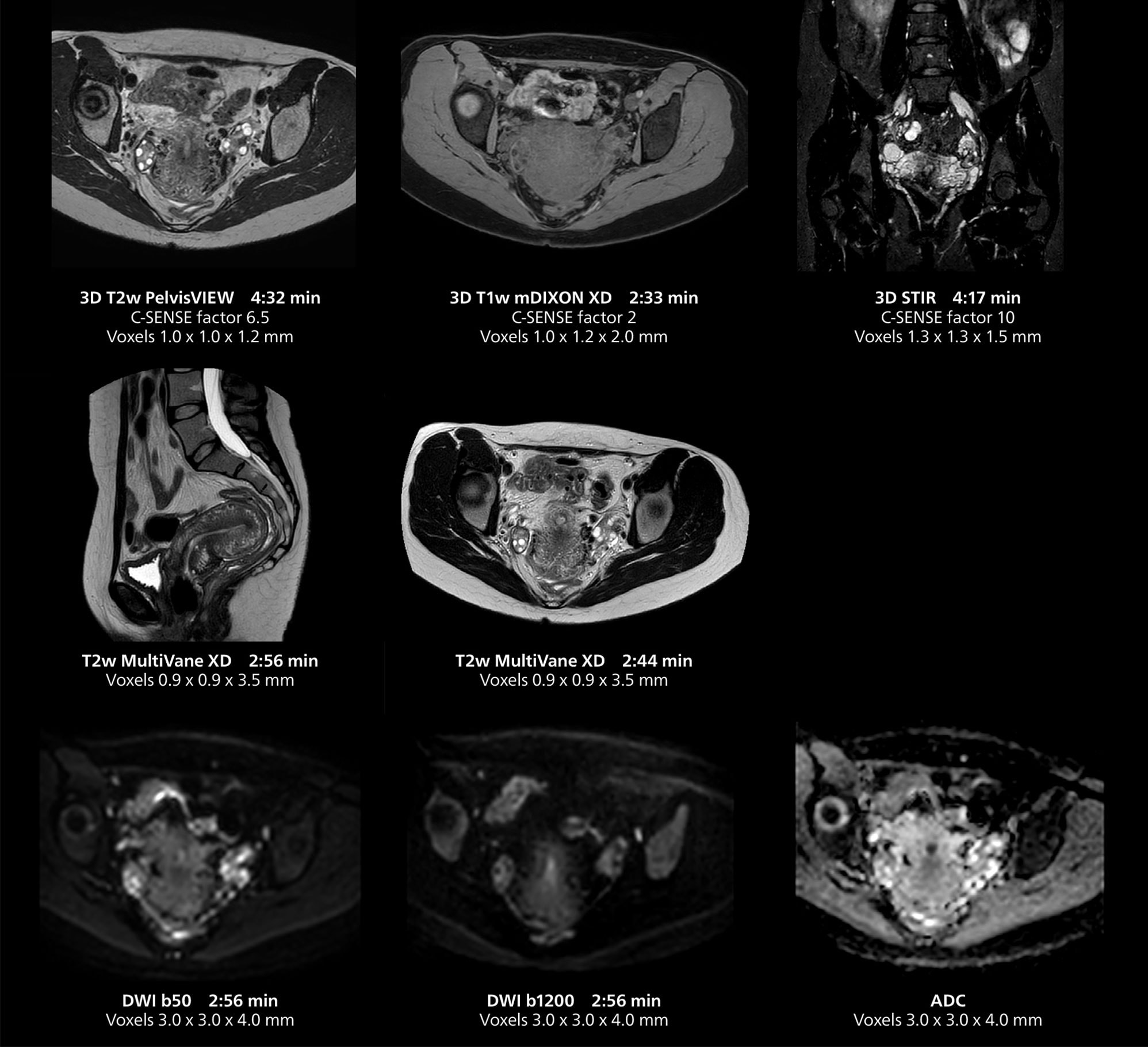 Irm du pelvis féminin