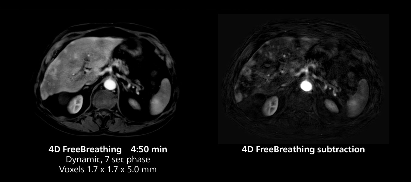 Irm du genou mri