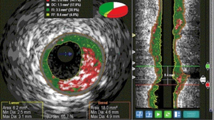 Échographie intravasculaire vh contourage auto