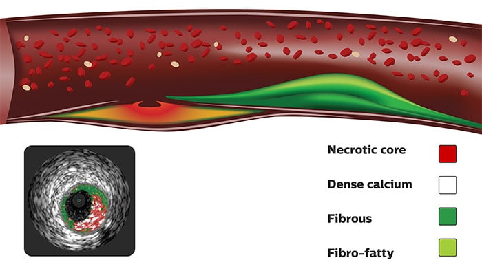 Échographie intravasculaire vh coloréetissus