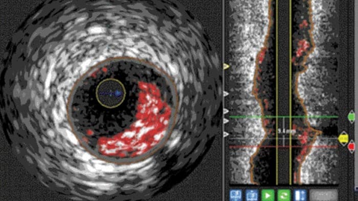 Échographie intravasculaire vh mesure lumière vaisseaux