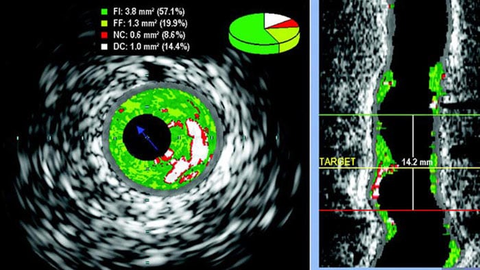 Échographie intravasculaire vh évaluation des lésions