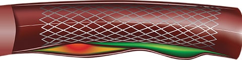 Échographie intravasculaire en nuances de gris