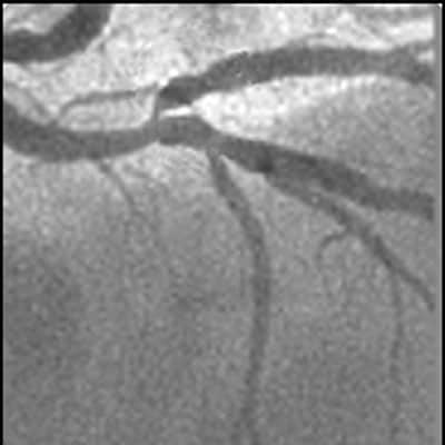 Lésions de bifurcation