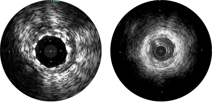 Supports biorésorbables