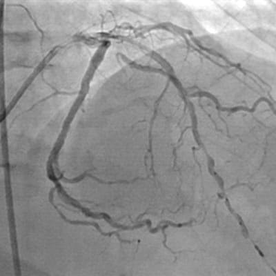 Lésions diffuses étendues