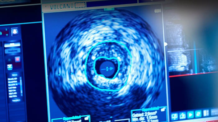 Échographie intravasculaire (IVUS)