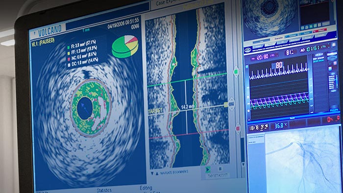 Échographie intravasculaire VH