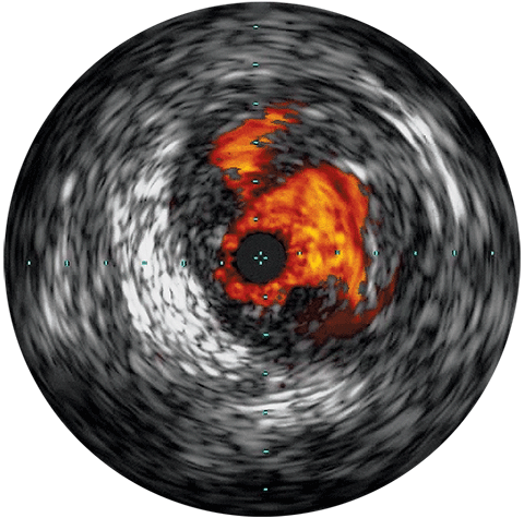 Les promesses de l’IVUS